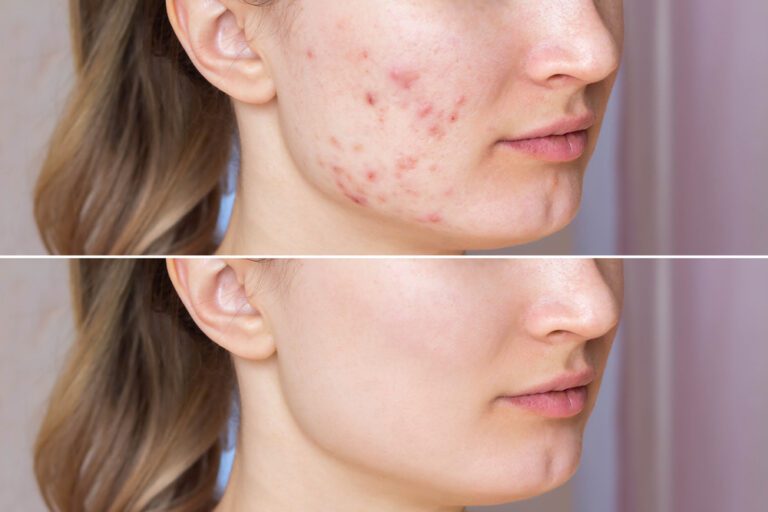 Een gave huid met deze tips: acné verhelpen